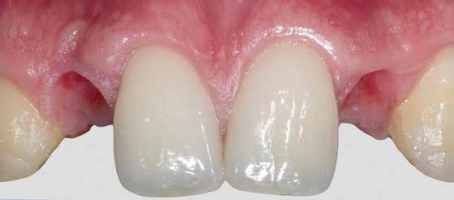 Traitement du secteur antérieur : dent ou implant