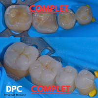 Érosion et usure DPC 2025