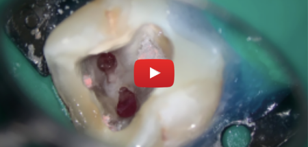 Replay Journée « Les erreurs en endodontie »