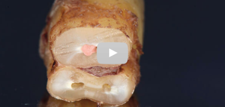 Replay Journée « Retraitement endodontique »