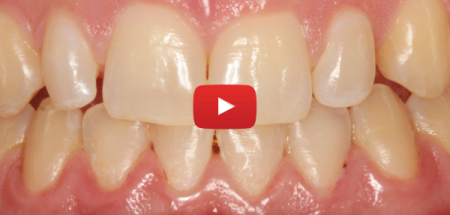 Replay Journée « L'espace interdentaire »