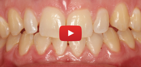 L'espace interdentaire