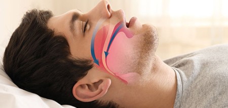 Traiter le syndrome d'apnée du sommeil (SOAS)