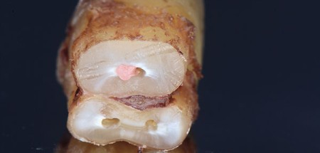 Retraitement endodontique