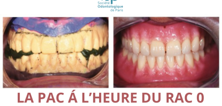 PAC à l'heure du RAC 0