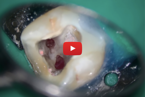 Replay Journée « Les erreurs en endodontie »