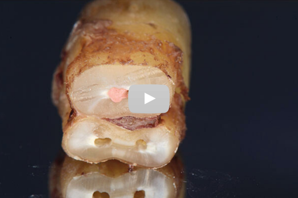 Replay Journée « Retraitement endodontique »