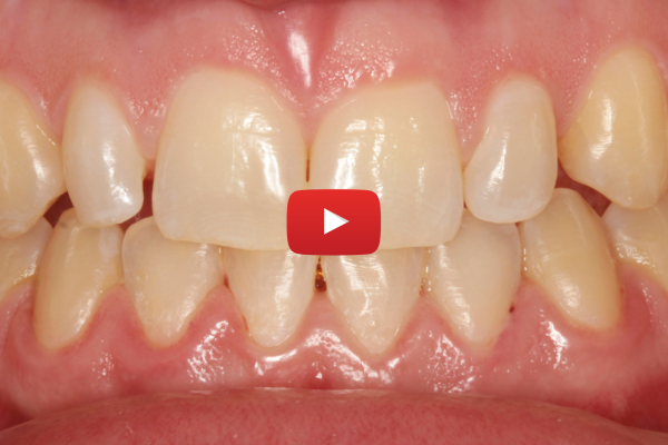 Replay Journée « L'espace interdentaire »